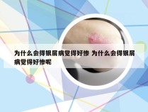 为什么会得银屑病觉得好惨 为什么会得银屑病觉得好惨呢