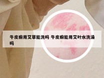 牛皮癣用艾草能洗吗 牛皮癣能用艾叶水洗澡吗