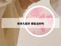 癣多久能好 癣能治好吗
