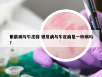 银屑病与牛皮藓 银屑病与牛皮癣是一种病吗?