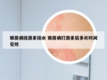 银屑病挂激素挂水 银屑病打激素后多长时间见效