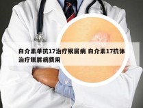 白介素单抗17治疗银屑病 白介素17抗体治疗银屑病费用