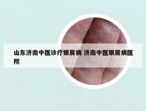 山东济南中医诊疗银屑病 济南中医银屑病医院