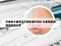 长春哪个医院治疗银屑病疗效好 长春银屑病研究所怎么样