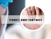牛皮癣好了 皮癣好了后留下黑印子