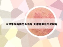 天津牛皮癣要怎么治疗 天津哪里治牛皮癣好