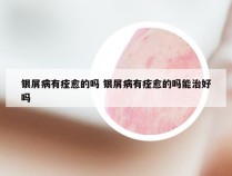 银屑病有痊愈的吗 银屑病有痊愈的吗能治好吗