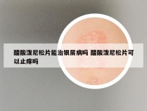 醋酸泼尼松片能治银屑病吗 醋酸泼尼松片可以止痒吗