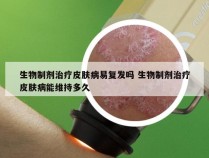 生物制剂治疗皮肤病易复发吗 生物制剂治疗皮肤病能维持多久