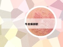 牛皮癣辞职