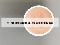小飞蓬治牛皮癣吗 小飞蓬能治疗牛皮癣吗