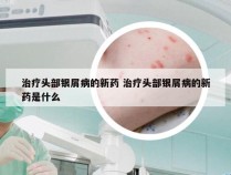 治疗头部银屑病的新药 治疗头部银屑病的新药是什么