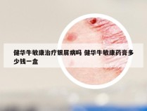 健华牛敏康治疗银屑病吗 健华牛敏康药膏多少钱一盒