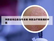 陕西省靖边县治牛皮癣 陕西治疗银屑病的中医