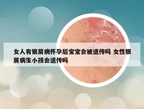 女人有银屑病怀孕后宝宝会被遗传吗 女性银屑病生小孩会遗传吗