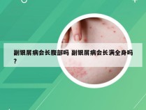 副银屑病会长腹部吗 副银屑病会长满全身吗?