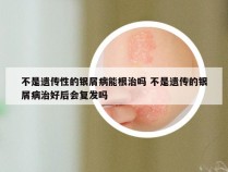 不是遗传性的银屑病能根治吗 不是遗传的银屑病治好后会复发吗
