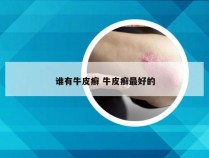 谁有牛皮癣 牛皮癣最好的