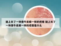 腿上长了一块像牛皮癣一样的疙瘩 腿上长了一块像牛皮癣一样的疙瘩是什么