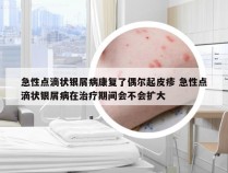 急性点滴状银屑病康复了偶尔起皮疹 急性点滴状银屑病在治疗期间会不会扩大