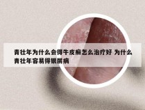 青壮年为什么会得牛皮癣怎么治疗好 为什么青壮年容易得银屑病
