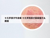 十几岁孩子牛皮癣 十几岁的孩子尿床是什么原因