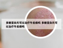 多糖蛋白片可以治疗牛皮癣吗 多糖蛋白片可以治疗牛皮癣吗