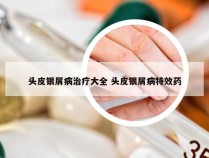 头皮银屑病治疗大全 头皮银屑病特效药