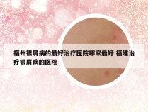 福州银屑病的最好治疗医院哪家最好 福建治疗银屑病的医院