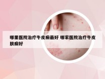 哪里医院治疗牛皮癣最好 哪家医院治疗牛皮肤癣好