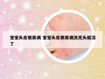宝宝头皮银屑病 宝宝头皮银屑病洗完头就没了