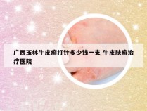 广西玉林牛皮癣打针多少钱一支 牛皮肤癣治疗医院