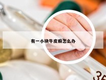有一小块牛皮癣怎么办