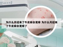 为什么月经来了牛皮癣会更痒 为什么月经来了牛皮癣会更痒了