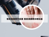 银屑病病理学结果 银屑病病理诊断标准