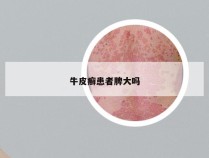 牛皮癣患者脾大吗