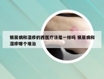 银屑病和湿疹的西医疗法是一样吗 银屑病和湿疹哪个难治