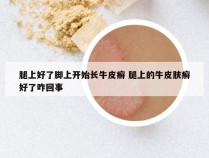 腿上好了脚上开始长牛皮癣 腿上的牛皮肤癣好了咋回事