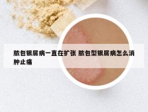 脓包银屑病一直在扩张 脓包型银屑病怎么消肿止痛