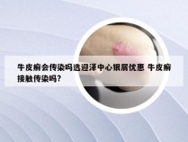 牛皮癣会传染吗选迎泽中心银屑优惠 牛皮癣接触传染吗?