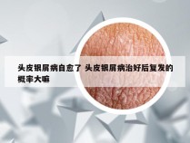 头皮银屑病自愈了 头皮银屑病治好后复发的概率大嘛