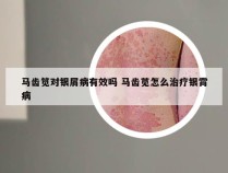 马齿笕对银屑病有效吗 马齿苋怎么治疗银霄病