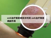 uvb治疗银屑病多长时间 uvb治疗银屑病副作用