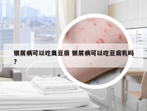 银屑病可以吃臭豆腐 银屑病可以吃豆腐乳吗?