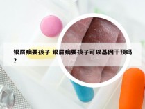 银屑病要孩子 银屑病要孩子可以基因干预吗?