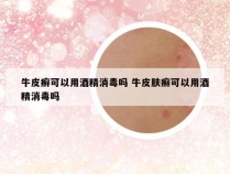 牛皮癣可以用酒精消毒吗 牛皮肤癣可以用酒精消毒吗