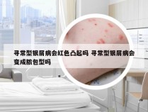 寻常型银屑病会红色凸起吗 寻常型银屑病会变成脓包型吗