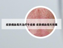 皮肤病血毒片治疗牛皮癣 皮肤病血毒片效果