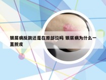银屑病反跳还是在原部位吗 银屑病为什么一直脱皮