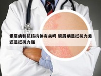 银屑病和抗核抗体有关吗 银屑病是抵抗力差还是抵抗力强